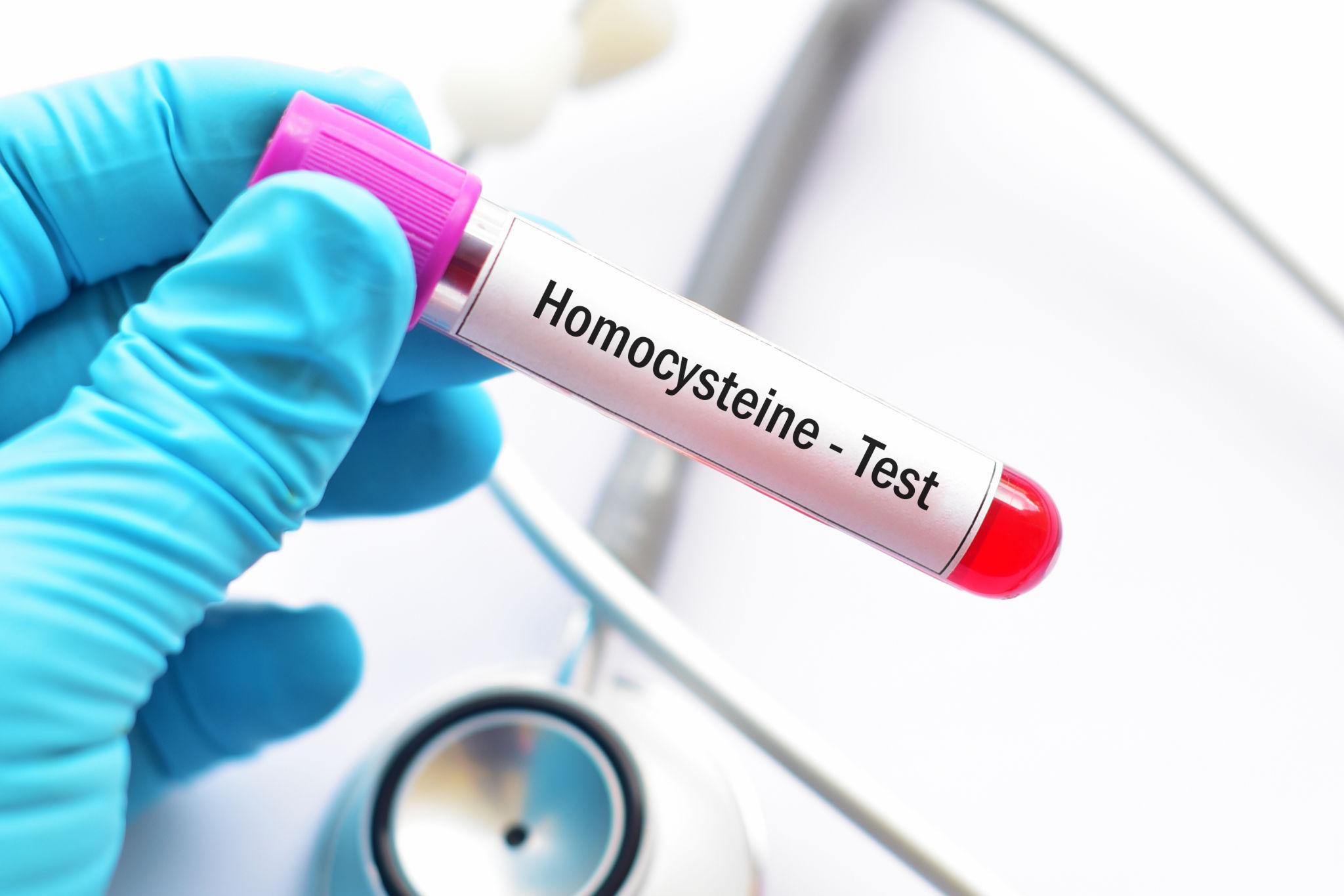 Blood testing for inflammation markers like CRP and homocysteine