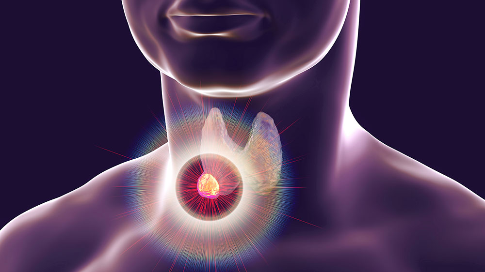 Thyroid Nodules: Can They be Reversed?