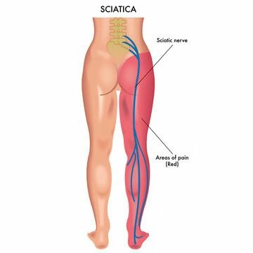 Illustration of sciatica pain, showing the sciatic nerve and its radiating pain from irritation or nerve pathology.